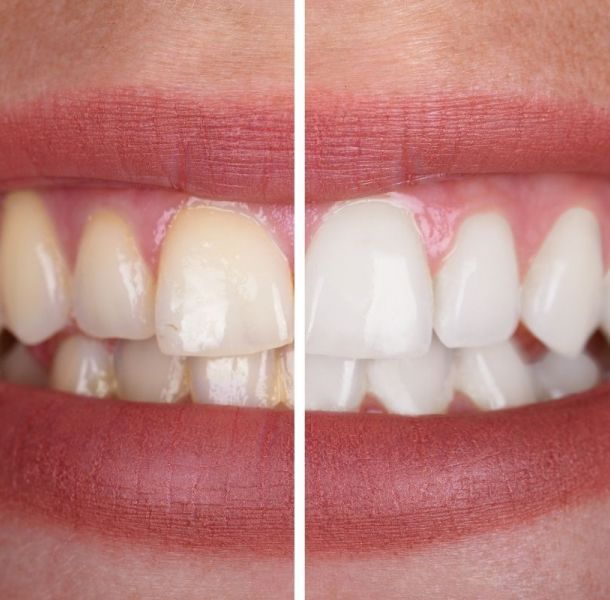 Los 6 Errores comunes sobre los Implantes Dentales 33