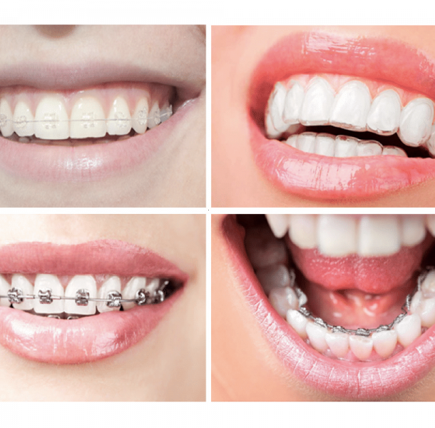 Los 6 Errores comunes sobre los Implantes Dentales 45