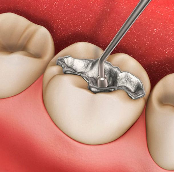 Razones por las que el verano es perfecto para blanquear los dientes 25