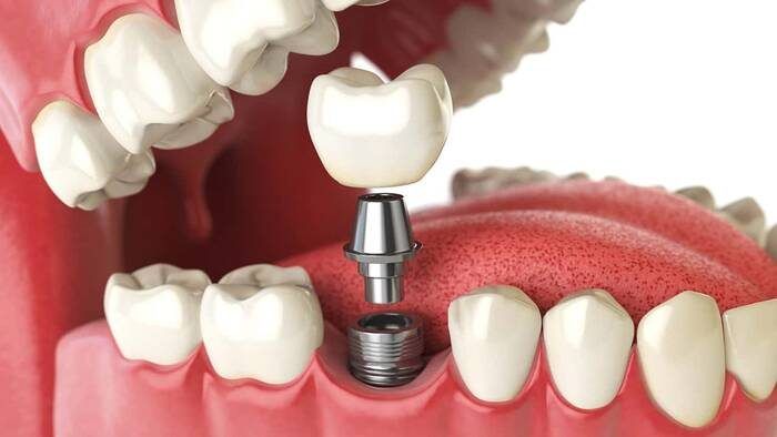 imagen de implantes dentales clinica dental salud natural one
