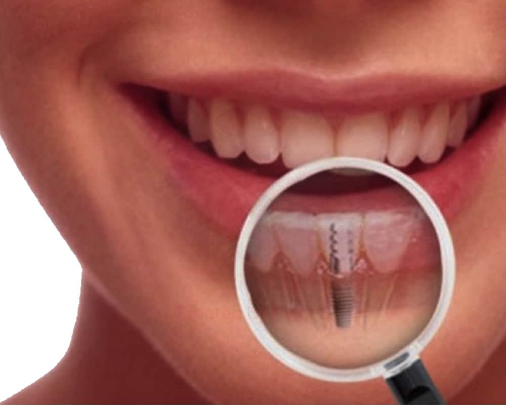imagen de implantes dentales Salud natural one