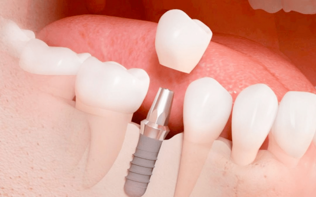 Implante dental Salud Natural One