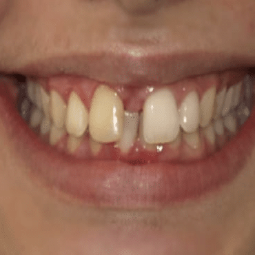 antes del tratamiento de ortodoncia invisible