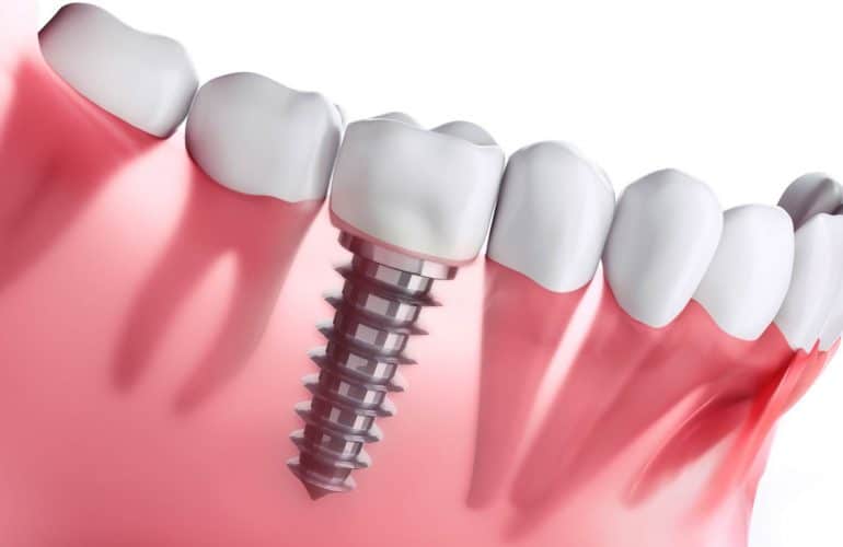 ¿Puede un implante dental causar rechazo?