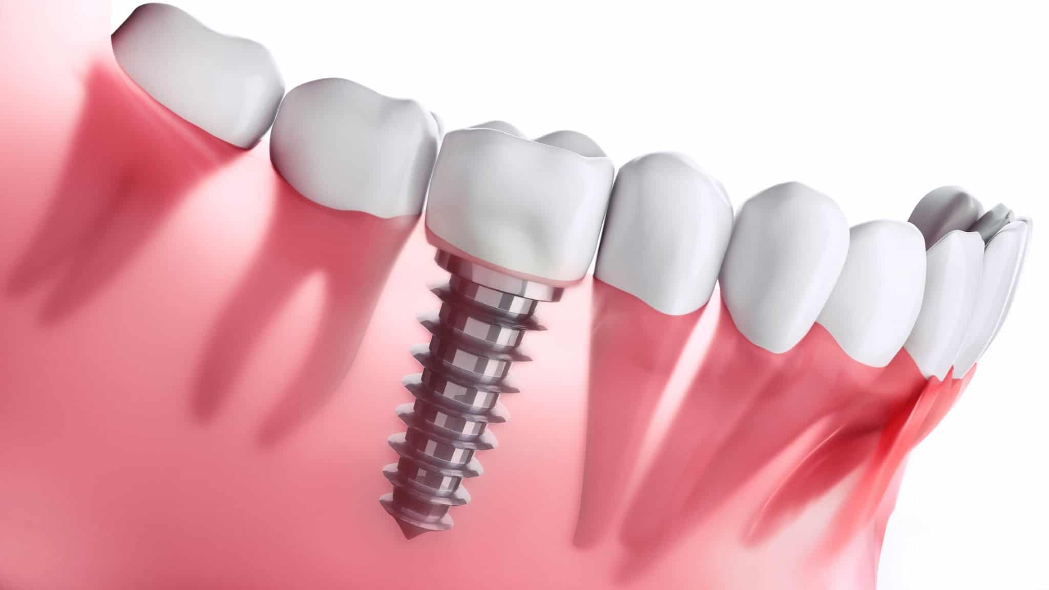 ¿Puede un implante dental causar rechazo?