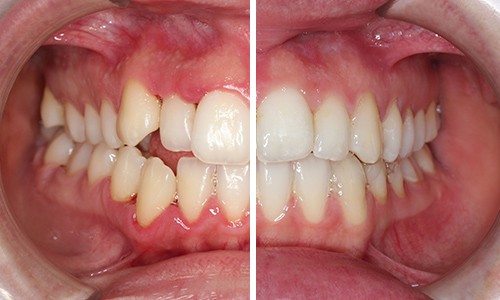 Antes y después de blanqueamiento dental