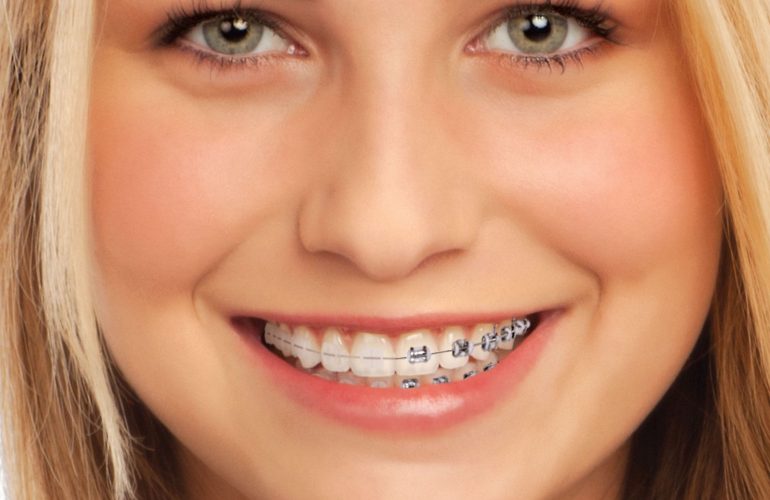 imagen de brackets-cerámica-ortodoncia-clinica-dental-madrid