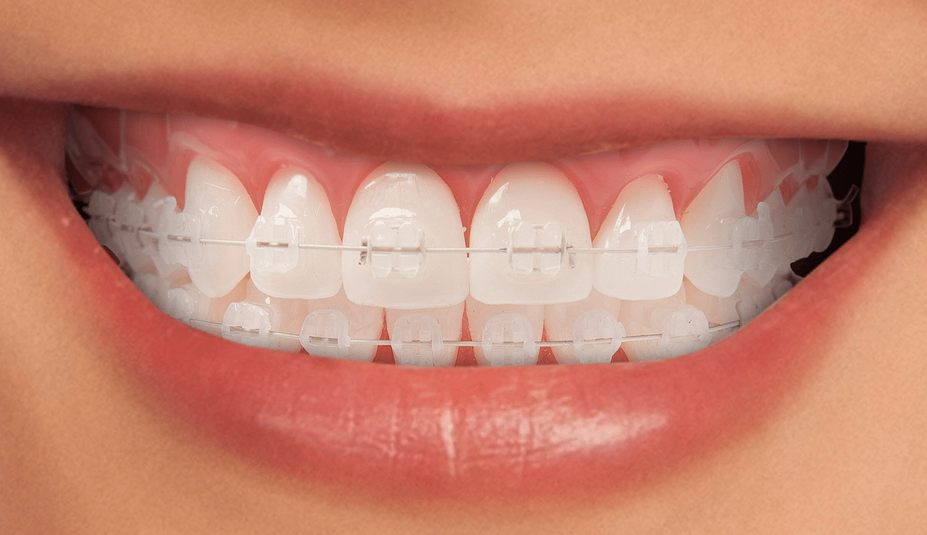 imagen de ortodoncia estetica brackets clinica dental salud natural one