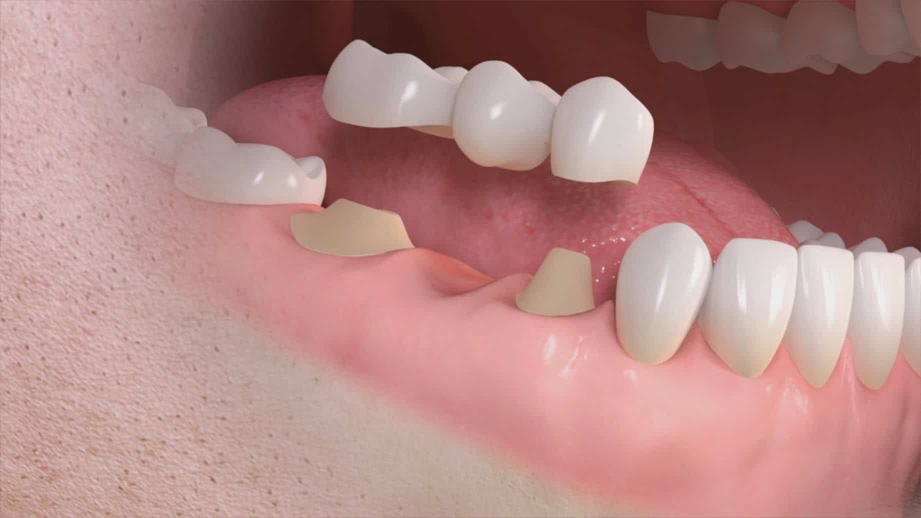 prótesis dental fija en clínica dental en madrid