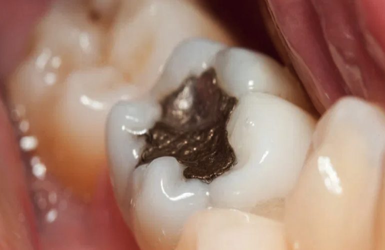 imagen de retirada segura de amalgamas de mercurio clinica dental salud natural one