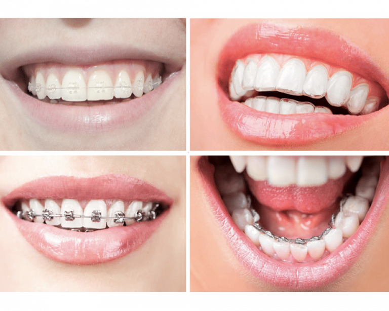 Conoce lo que debes saber sobre los brackets antes de ponertelos Conoce lo que debes saber sobre los brackets antes de ponertelos