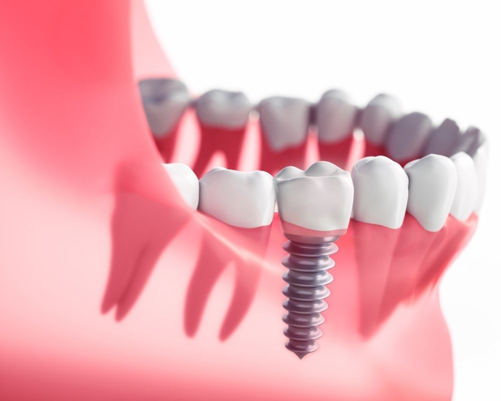 imagen de Implantes dentales o puentes dentales clinica dental en madrid