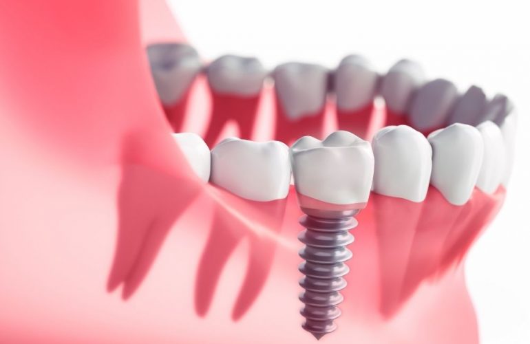 imagen de Implantes dentales o puentes dentales clinica dental en madrid