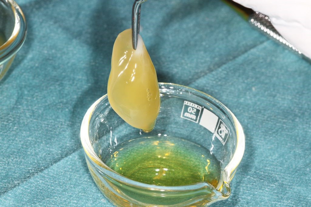 Ozonoterapia 2 Plasma rico en factores de crecimiento para la ozonoterapia dental