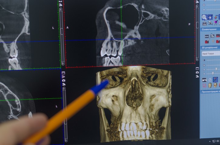 En qué consiste en Cone Beam Dental y para qué sirve 1 pruebas cbct o cone beam en Madrid