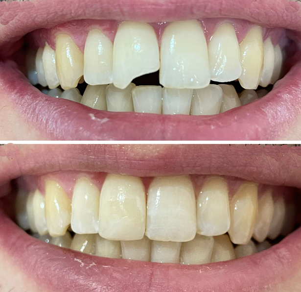 Empastes sin bisfenoles 1 Empastes sin bisfenoles