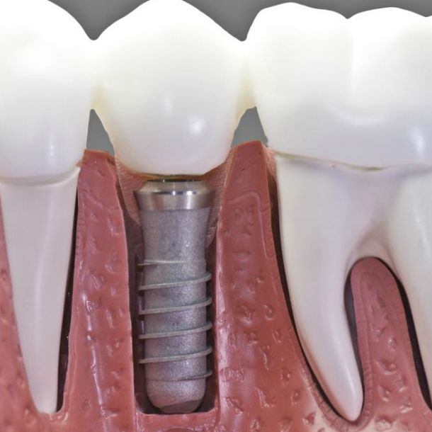 Guía definitiva sobre Implantes Dentales