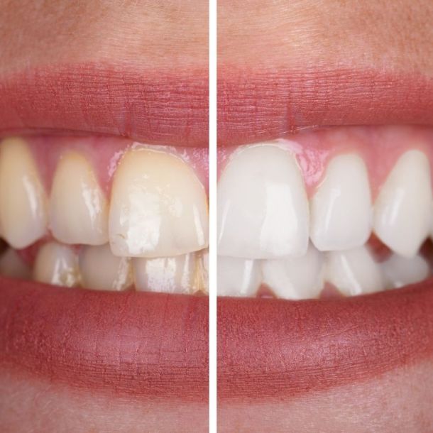 Razones por las que el verano es perfecto para blanquear los dientes