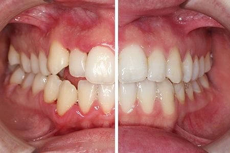Tratamiento de Ortodoncia Invisible - Antes y Después