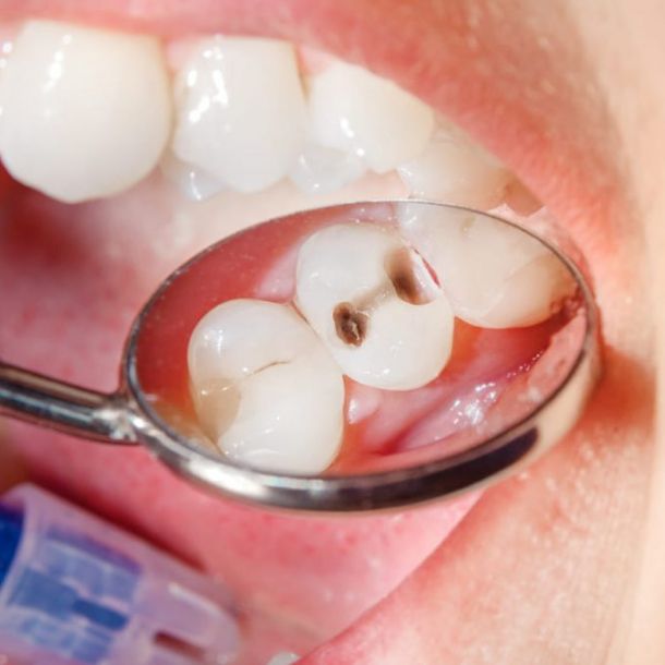 ¿Por qué algunos individuos son más vulnerables a sufrir de caries que otros?
