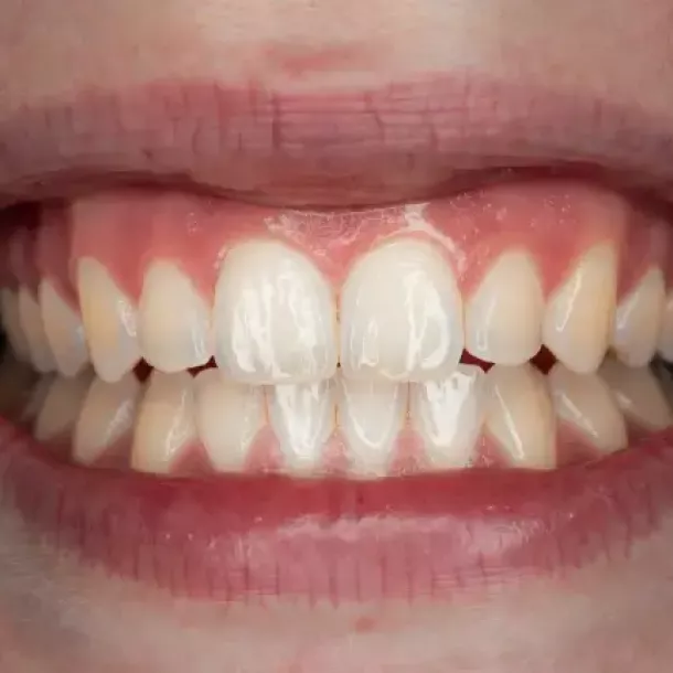 Piezas Dentales: Guía Completa de Tipos y Cuidado Natural