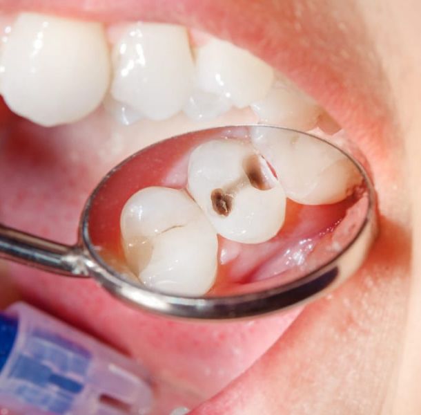¿ES MEJOR UN PUENTE DENTAL O IMPLANTES DENTALES? 23