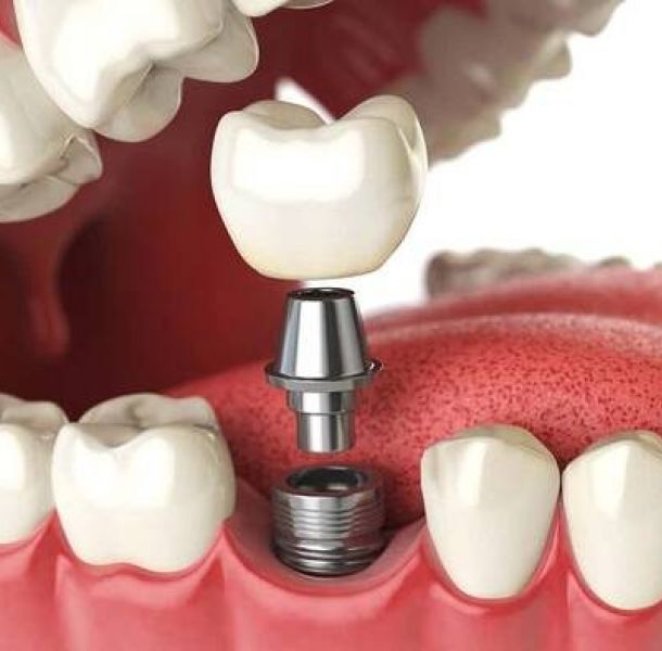 Implantes Circonio Madrid: Guía Completa 2026 - Precio, Ventajas y Comparativa 45