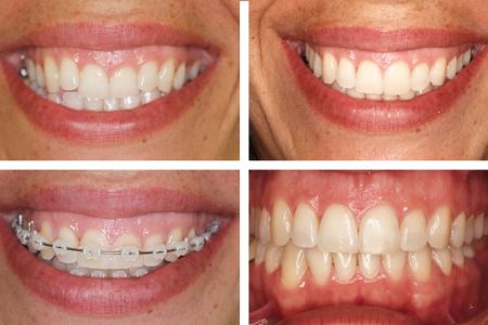 Antes y después de usar brackets