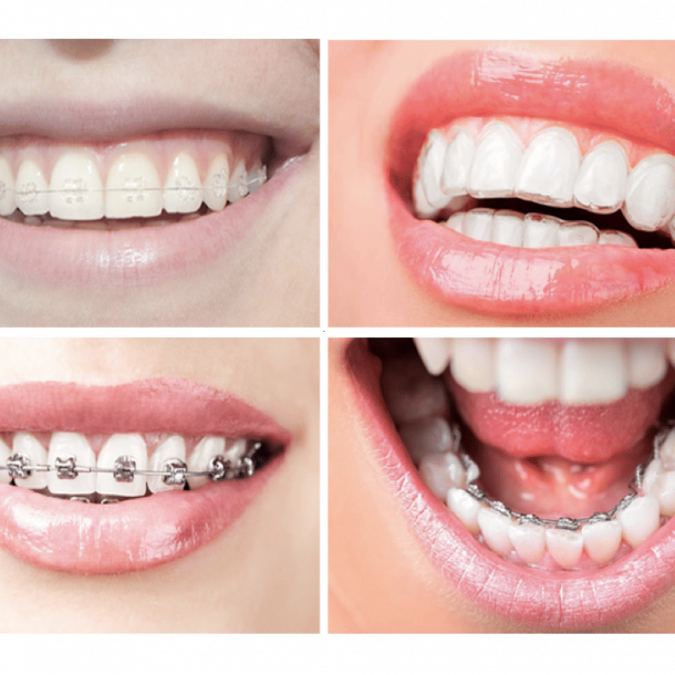 Todo lo que debes saber sobre Brackets