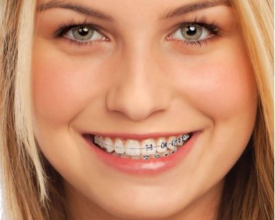 imagen de brackets-cerámica-ortodoncia-clinica-dental-madrid