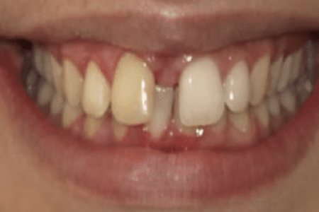 antes del tratamiento de ortodoncia invisible