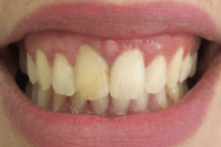 después del tratamiento de ortodoncia invisible en nuestra clínica dental en madrid