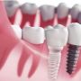 Implantes Circonio Madrid: Guía Completa 2026 - Precio, Ventajas y Comparativa 2