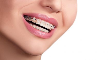 Mujer con aparato metálico, brackets en Madrid