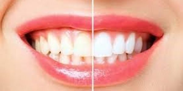 blanqueamiento dental