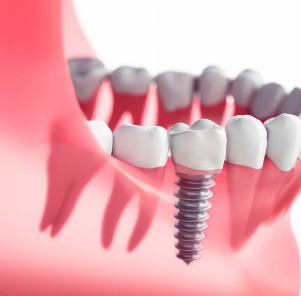 Implantes Circonio Madrid: Guía Completa 2026 - Precio, Ventajas y Comparativa 39