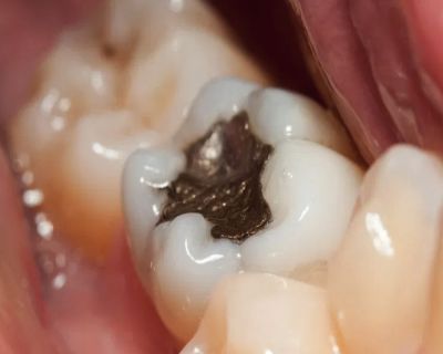 protocolo para retirar la amalgama dental
