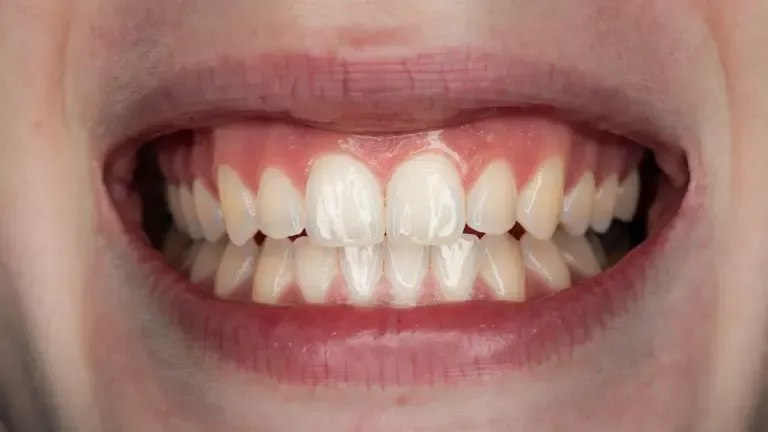 Piezas Dentales: Guía Completa de Tipos y Cuidado Natural