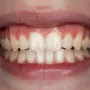 Piezas Dentales: Guía Completa de Tipos y Cuidado Natural 4