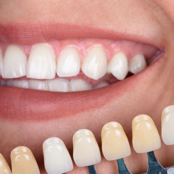 ¿Para qué sirven las carillas dentales?