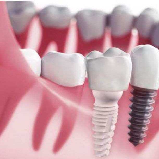 Implantes Circonio Madrid: Guía Completa 2026 – Precio, Ventajas y Comparativa