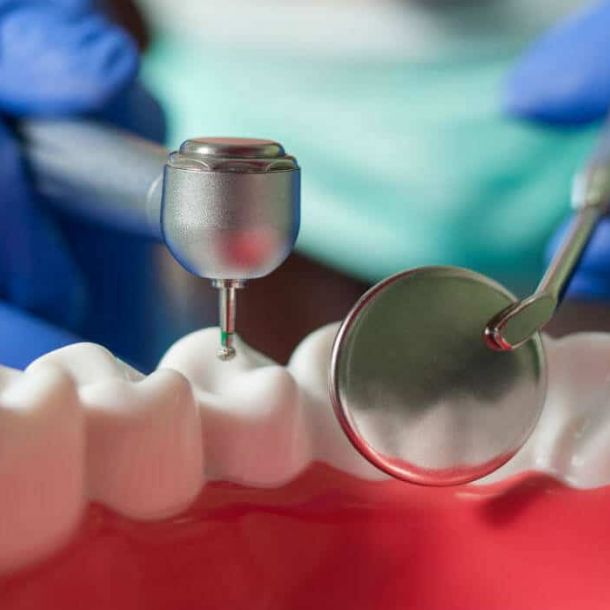 Qué es una endodoncia