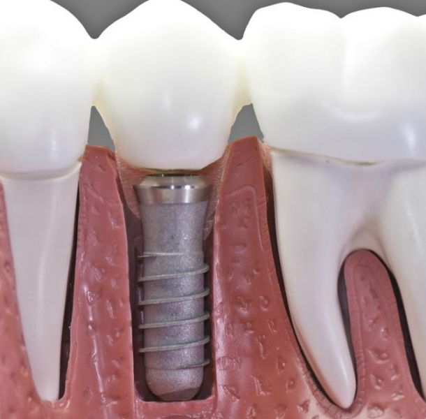 Implantes Circonio Madrid: Guía Completa 2026 - Precio, Ventajas y Comparativa 29