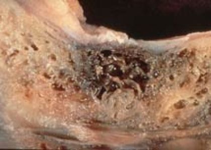 Osteonecrosis cavitacional que se pueden tratar con ozonoterapia en Madrid