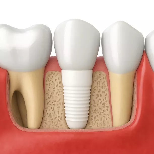 Implantes dentales de circonio: estética y salud sin compromiso