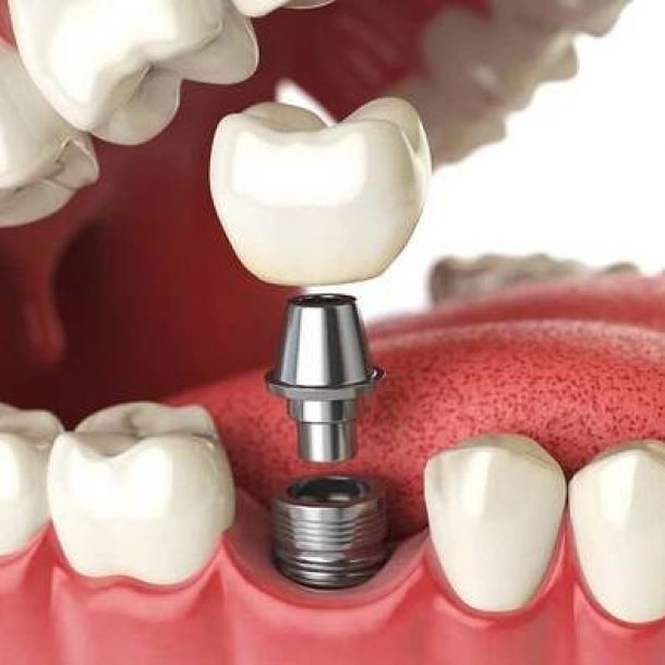 Los 6 Errores comunes sobre los Implantes Dentales