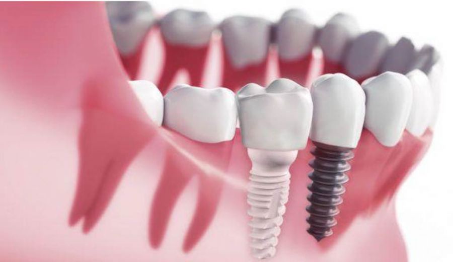 Implantes Circonio Madrid: Guía Completa 2026 – Precio, Ventajas y Comparativa